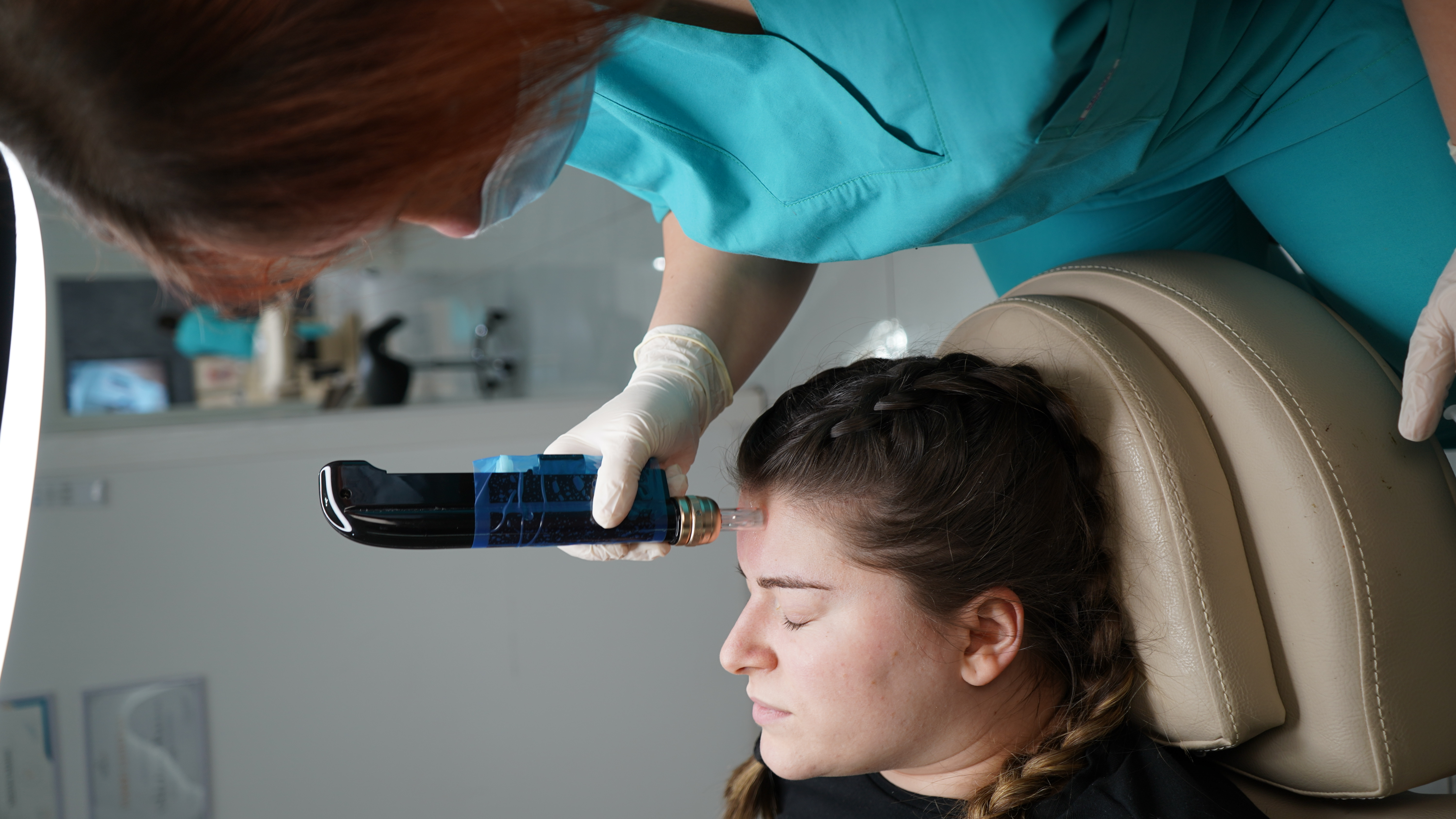 Microneedling — 2